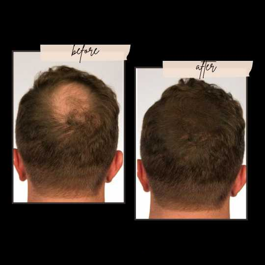 Toppik Hair Building Fiber 3-in-1 Combo Pack. This Set Includes Toppik Hair Fiber, Fiber Hold Spray &amp; Hairline Optimizer Comb