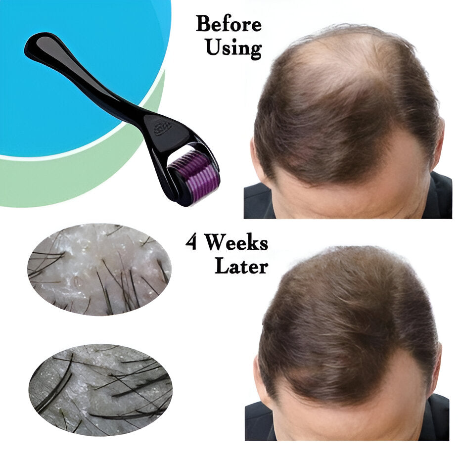 Derma Roller Hair Therapy Micro-Needle | Derma Roller for Hair re-growth &amp; Skin For Male And Female